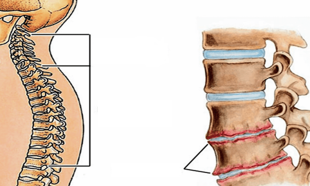 How the osteochondosis of the spine appears