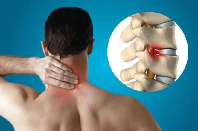 Osteochondrosis of the spine